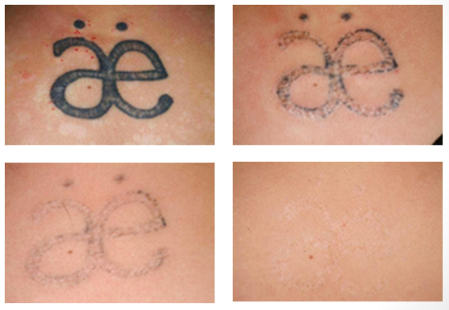 Does Laser Tattoo Removal Work or Not? | Good Tattoo Ideas